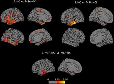 Morphological Changes in Cortical and Subcortical Structures in Multiple System Atrophy Patients With Mild Cognitive Impairment